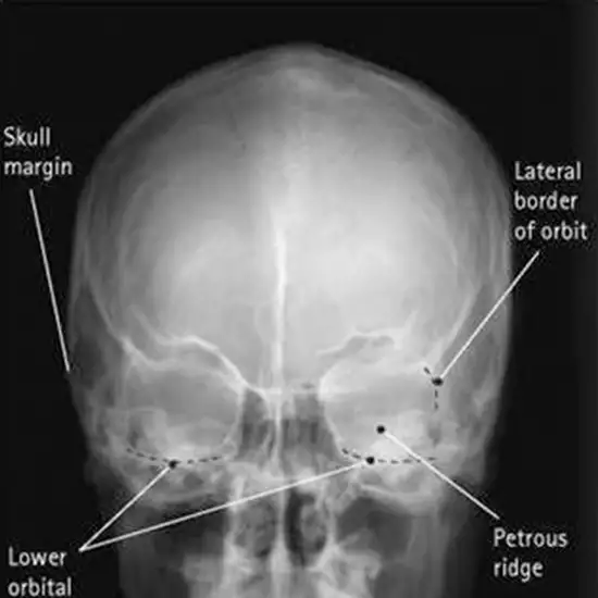 x-ray internal acoustic meatus per orbital test